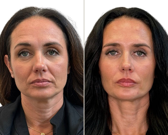 Before and after results at Renew Wellness & Aesthetics Oklahoma City