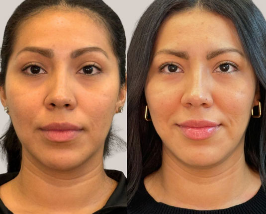 Before and after results at Renew Wellness & Aesthetics Oklahoma City