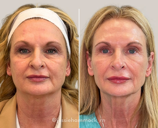 Before and after results at Renew Wellness & Aesthetics Oklahoma City