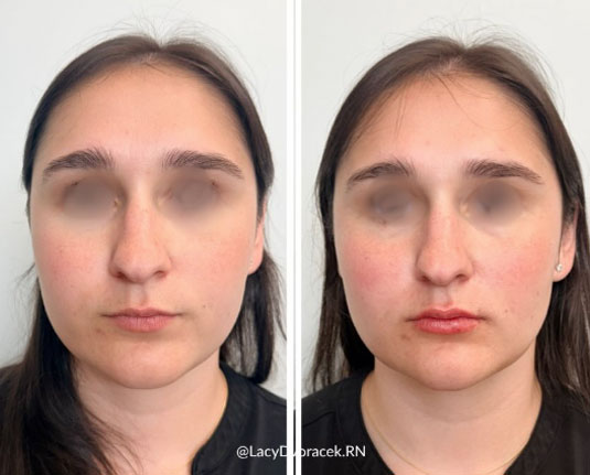 Before and after results at Renew Wellness & Aesthetics Oklahoma City