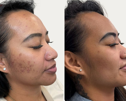 Before and after results at Renew Wellness & Aesthetics Oklahoma City